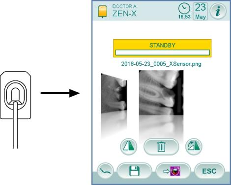 5.9. ΕΝΣΩΜΑΤΩΜΕΝΟΣ ΑΙΣΘΗΤΗΡΑΣ ZEN-Xi Ο ενσωματωμένος αισθητήρας ZEN-Xi είναι μια ιατρική συσκευή για την απόκτηση σε ηλεκτρονική μορφή ενδοστοματικών ακτινογραφιών μέσω διασύνδεσης με την κονσόλα