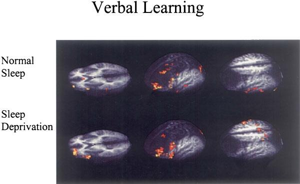 fmri περιοχικής εγκεφαλικής δραστηριότητας κατά τη διάρκεια μιας προσπάθειας λεκτικής μάθησης