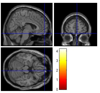 Precentral gyrus Precuneus Superior