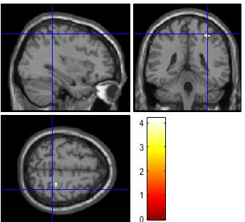 Parahippocampal gyrus Posterior cingulate (BA 23,