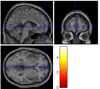 Precuneus Superior temporal gyrus Superior frontal