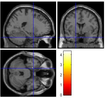 Cingulate gyrus Hippocampus