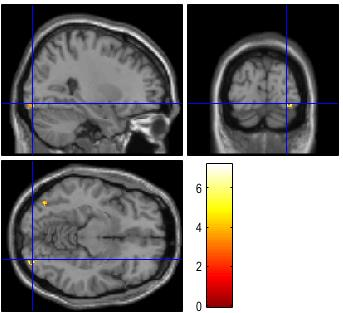 Inferior frontal gyrus Fusiform