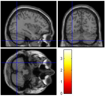 Inferior parietal lobule Inferior temporal