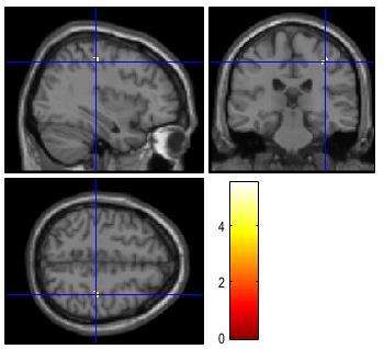 Medial frontal gyrus Lingual gyrus