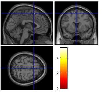 Precentral gyrus Supramarginal gyrus