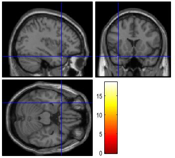 Middle occipital gyrus Inferior