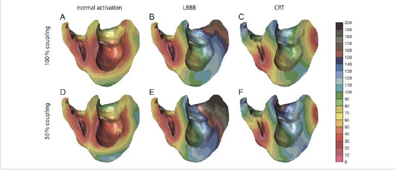 Activation sequence of ventricles An LBBB electrocardiogram type may be caused by either a block in the left branch of the ventricular conduction system or by uncoupling in the working myocardium.