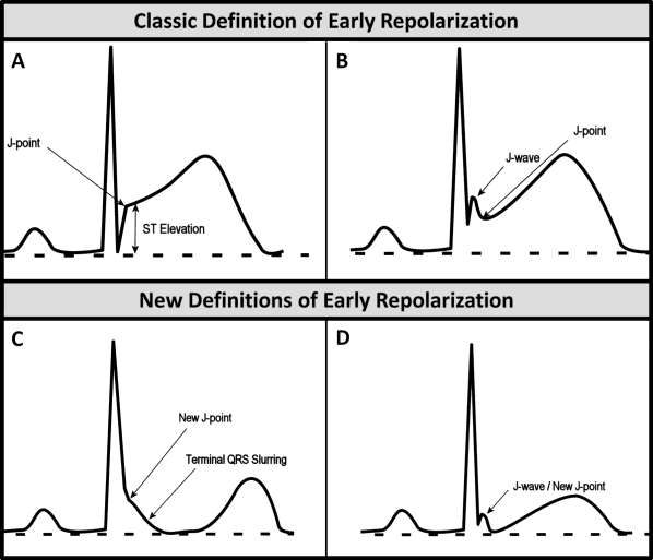 Classic definition of early repolarisation based on ST elevation at