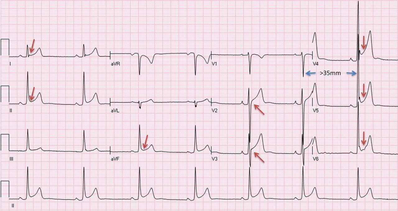 Isolated increase of QRS voltages ECG of a 29-year-old