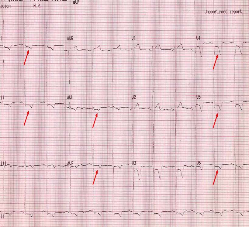Abnormal ECG in a patient with hypertrophic
