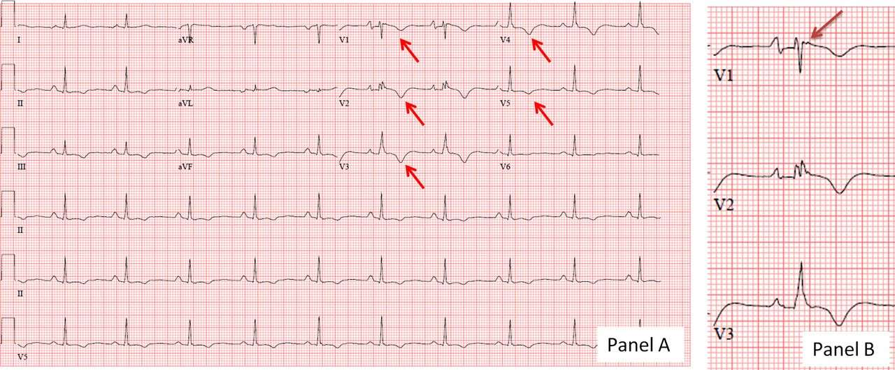 ECG from a patient with arrhythmogenic right ventricular