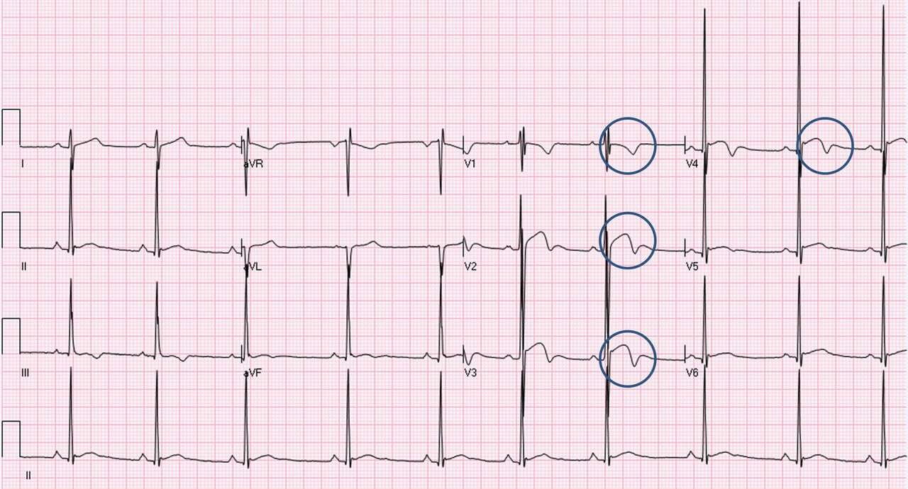 ECG from a 17-year-old black/african soccer player demonstrating domed ST elevation followed