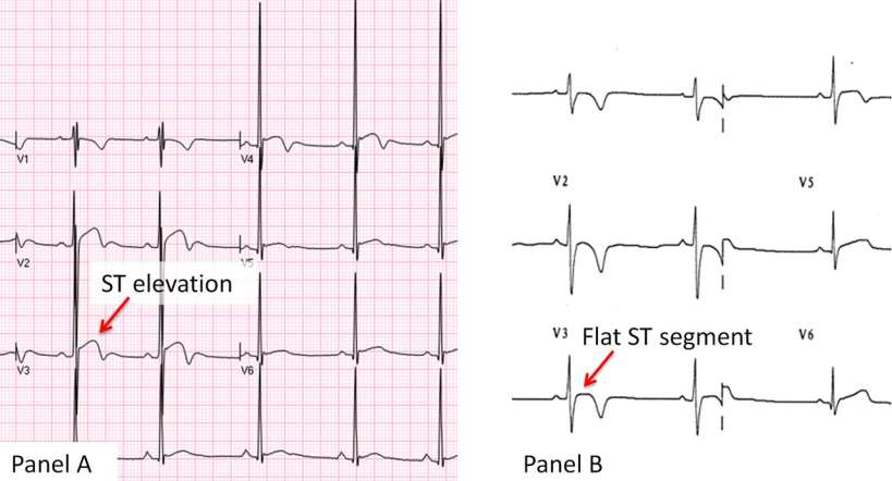 Normal variant repolarisation changes in a black/african athlete characterised by domed ST