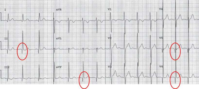 Abnormal ECG in a patient with hypertrophic