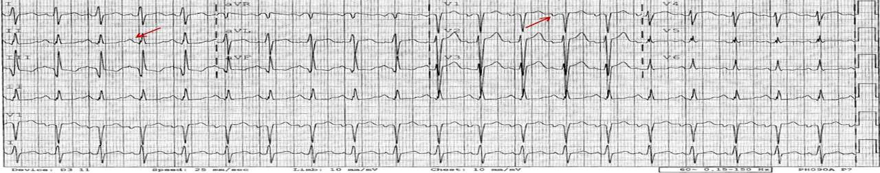 Left atrial enlargement ECG in a patient with hypertrophic cardiomyopathy showing left atrial enlargement LAE is defined as a prolonged P wave duration of >120 ms in leads I or