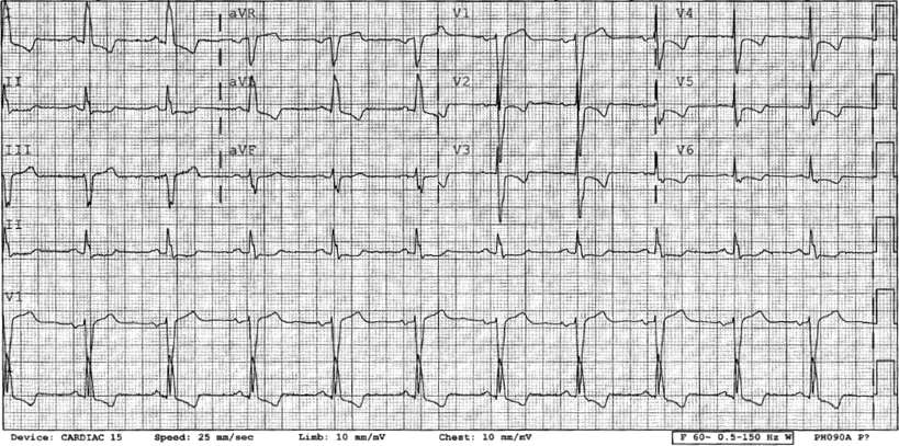 Abnormal ECG in a patient with hypertrophic cardiomyopathy showing complete left bundle branch block (QRS