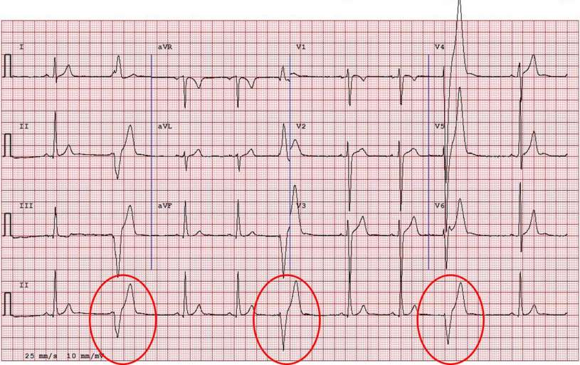 ECG from a patient with arrhythmogenic right ventricular