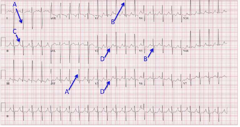 ECG from a patient