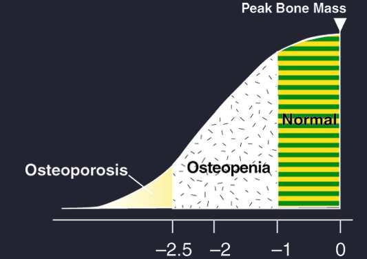 T-vrednost DIJAGNSTIČKI KRITERIJUMI (WH) Normalne vrednosti: BMD T-vrednost -1,0 ili veća steopenija (smanjena gustina kostiju): BMD T-vrednost