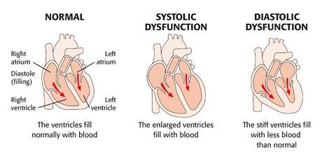 HF PATHOPHYSIOLOGY