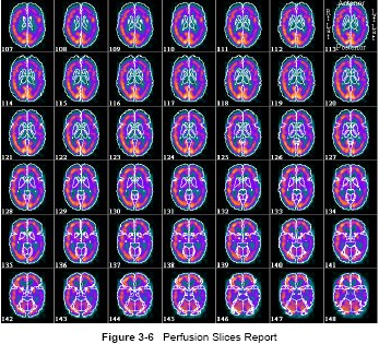 Cortical 3D and slices Perfusion Report Σύγκριση της αιμάτωσης ενός ασθενούς με βάση δεδομένων φυσιολογικών ατόμων Μία πολύ χρήσιμη δυνατότητα που μας παρέχει το συγκεκριμένο λογισμικό είναι αυτή της