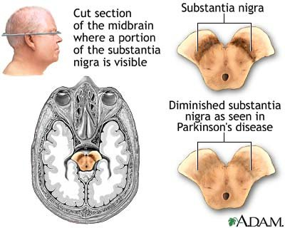 Εικόνα 1. Η εκφύλιση των ντοπαμινεργικών νευρώνων της μέλαινας ουσίας (substantia nigra) αποτελεί την αιτία της νόσου Parkinson 1.1.3 Κλινική συμπτωματολογία Τα συμπτώματα μπορεί να κυμαίνονται ανάλογα με το άτομο, αλλά και τον ρυθμό προόδου της νόσου.