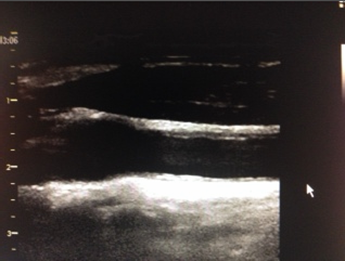 Εκτίµηση των καρωτίδων Triplex καρωτίδων Ultrasound examination of the carotid arteries with measurement of intima-media thickness (IMT) and/or the presence of plaques has been shown to predict the