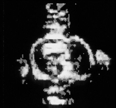 Σχηµατισµός εικόνας 2D µε χρήση µεθόδων Fourier: Η µέθοδος Spin warp Η µέθοδος αυτή είναι ιδιαίτερα ευαίσθητη σε ανοµοιογένειες του πεδίου Β0 και εγκαταλήφθηκε µετά την ανακάλυψη της µεθόδου