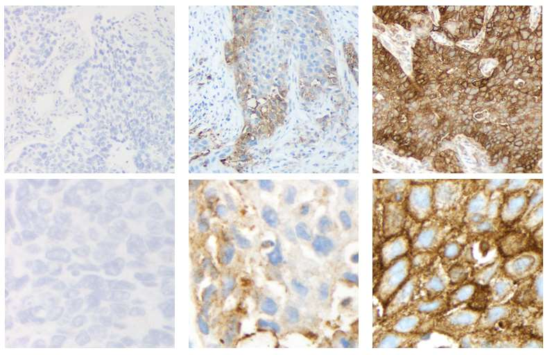 40 magnification 5 magnification Examples of PD-L1 IHC staining of NSCLC samples using the clinical trial assay TPS <1% TPS 1 49% TPS 50% Brown chromagen: PD-L1 staining; blue