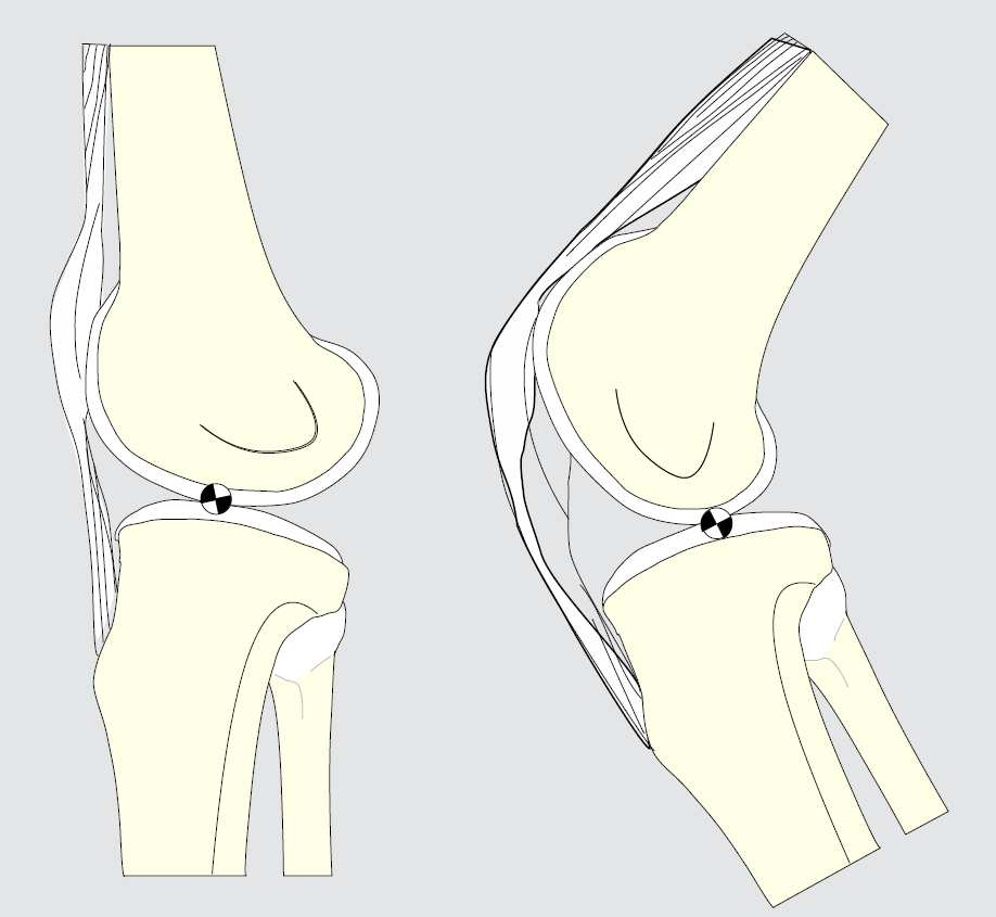 Σχήμα 2.1: Οδήγηση Επιγονατίδας κατά την Κάμψη Γόνατος. Καθώς το γόνατο κάμπτεται κι εκτείνεται, η επιγονατίδα έλκεται προς τα έξω, λόγω της σύσπασης του τετρακεφάλου μυός.