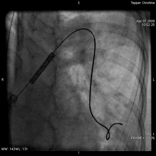 Παρουσίαση περιστατικού (2) CP stent 34mm