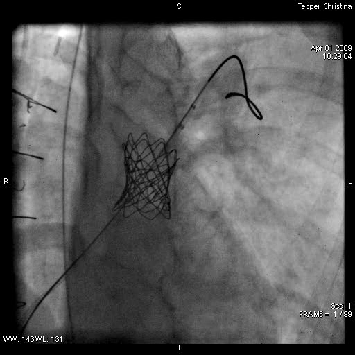 Παρουσίαση περιστατικού (2) RVOT-αγγειογραφία Post- CP