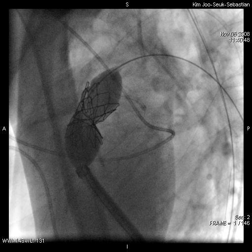 Παρουσίαση περιστατικού (3) Dilatation Numed 2.