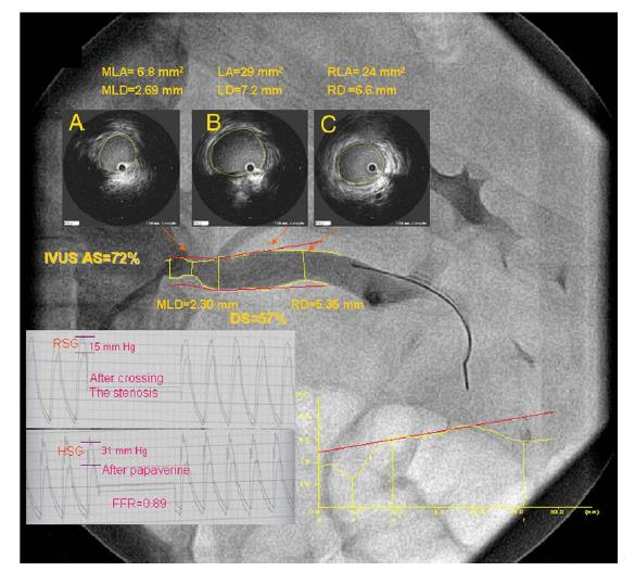 Cath lab data for ARAS