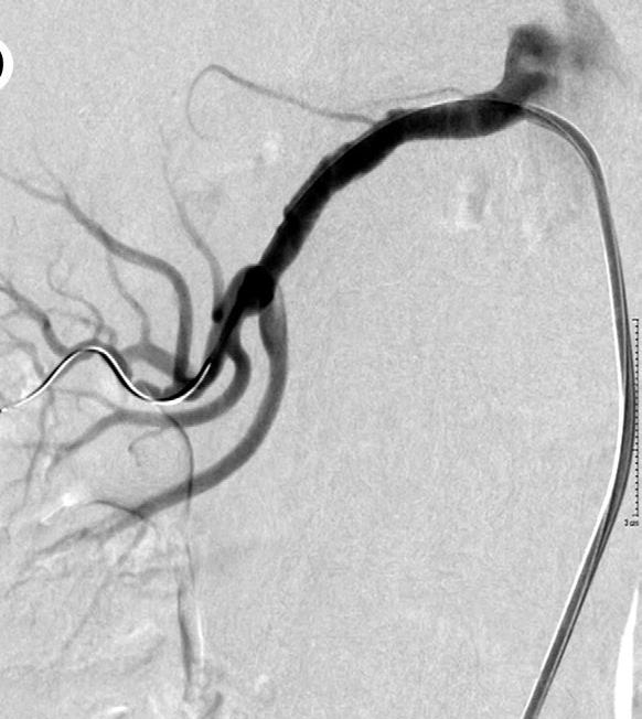 PTRA for FMD-RAS