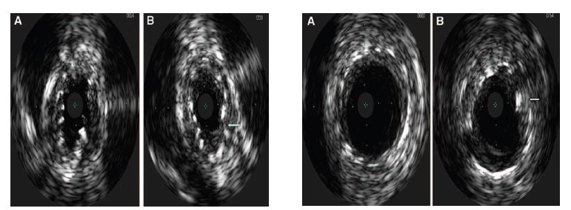 IVUS after FMD-RAS stenting Raju MG,