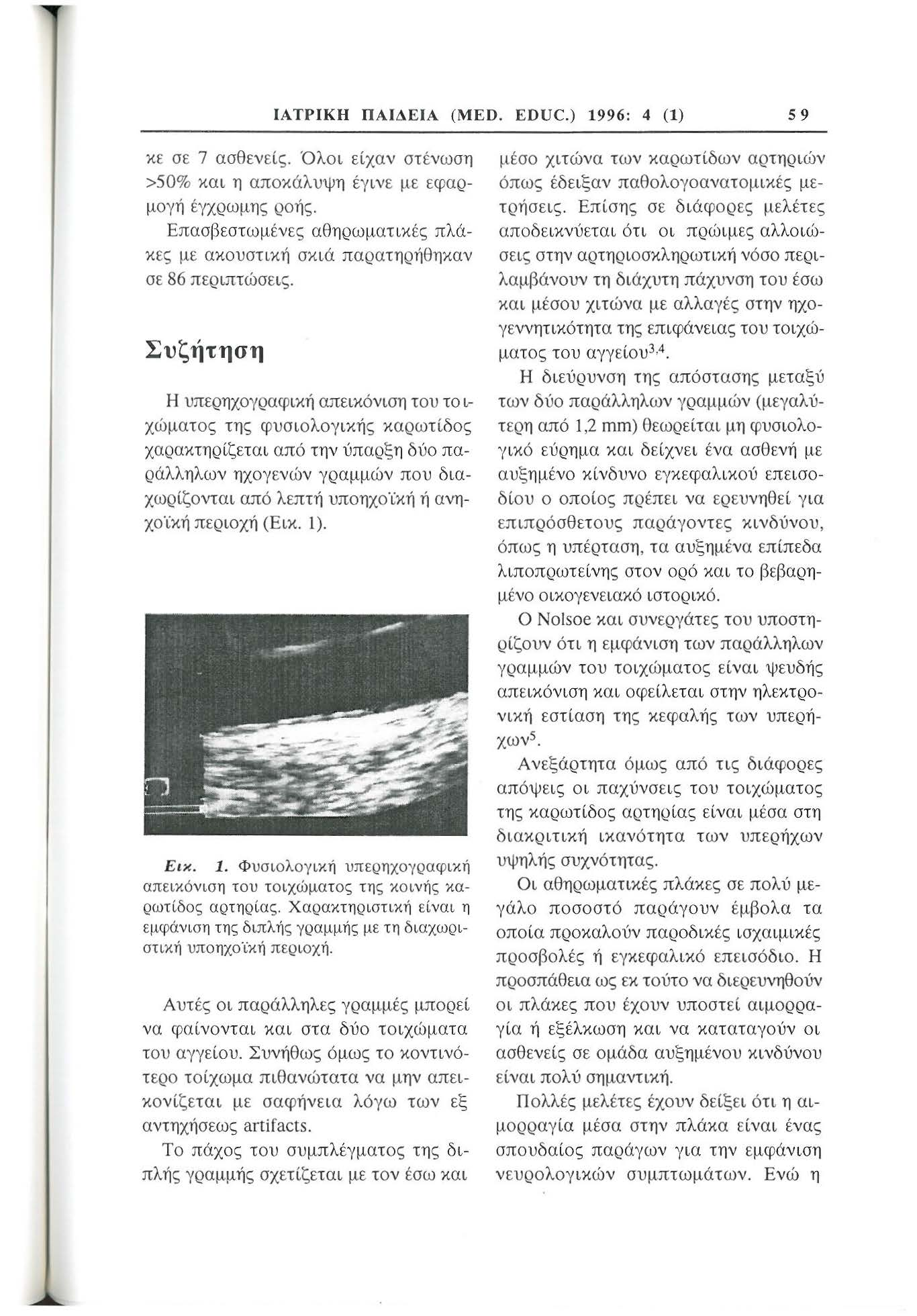 ΙΑΤΡΙΚΉ ΠΑΙΔΕΙΑ (MED. EDUC.) 1996: 4 (1) 59 χε σε 7 ασθενείς. Όλοι είχαν στένωση >50% και η αποκάλυψη έγινε με εφαρμογή έγχρωμης ροής.