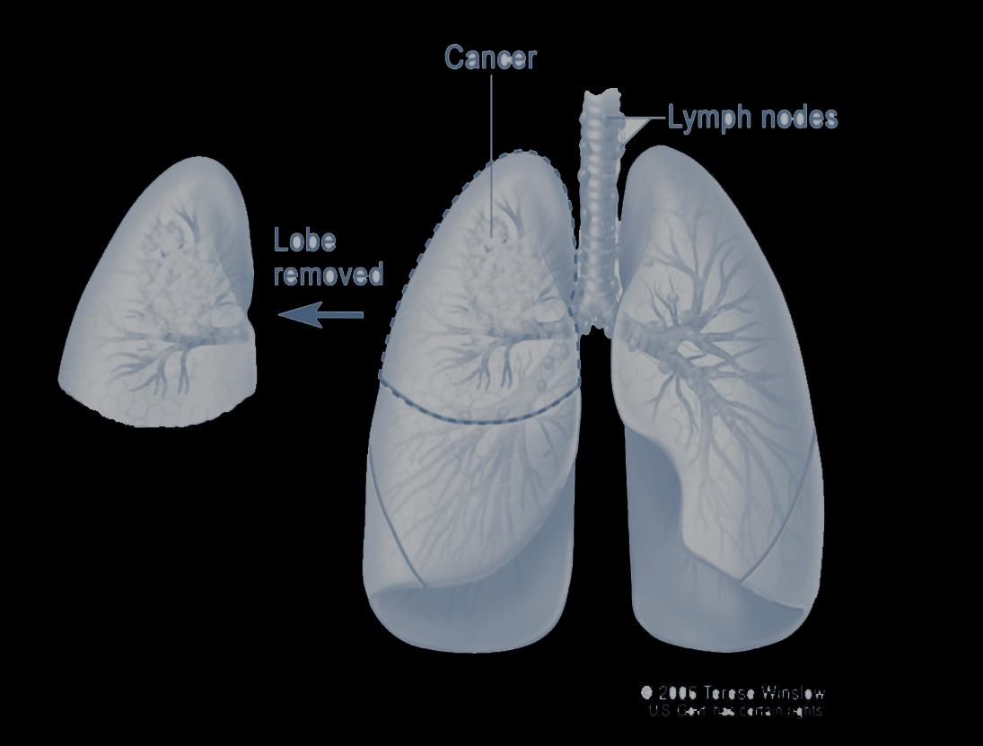 Η πιο συχνή εμφάνιση AF αφορά τη μετεγχειρητική περίοδο Χειρουργική καρκίνου πνεύμονος: 12.