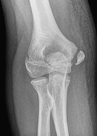 Little leaguer s elbow MR Imaging in Congenital and Acquire Disorders