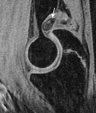 Ασταθής OCD MR Imaging in Congenital and Acquire Disorders of the