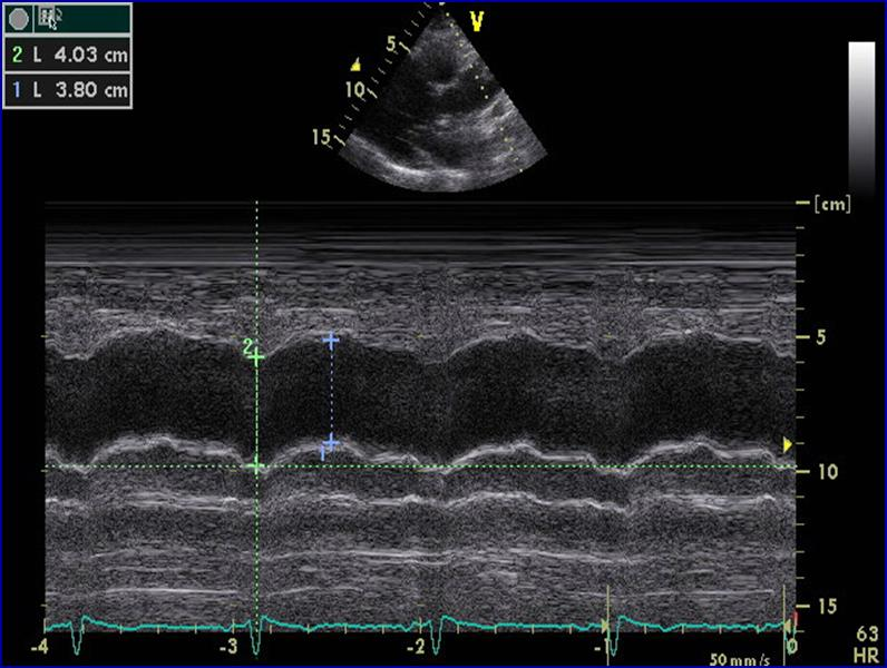 25 Flow mediated dilatation 20 FMD.