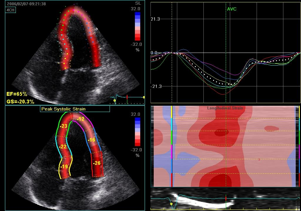 An example of a RA patient with impaired baseline mean longitudinal strain (-16,7%). Apoptotic markers were increased: Fas=667.14 pg/ml and Caspase- 9=1.