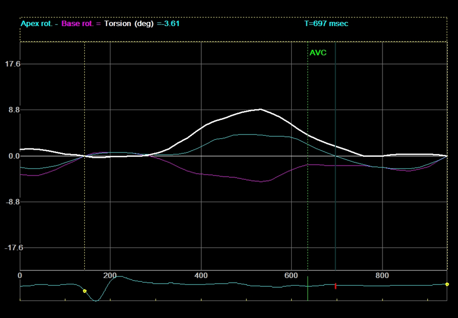 Healthy MVO EEF 33% 75 % 70 msec RA without CAD MVO EEF