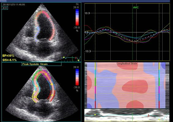 An example of a RA patient with CAD (LAD and D1) and impaired baseline mean longitudinal strain (-6%) After 3-hours of