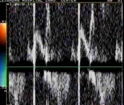 Ikonomidis I J Am Coll Cardiol 2004;43:1075 81 Adamantiades-Behcet's disease (ABD) prediction of events Impaired aortic distensibility E/FPV >1,5 Recurrent venous thrombosis