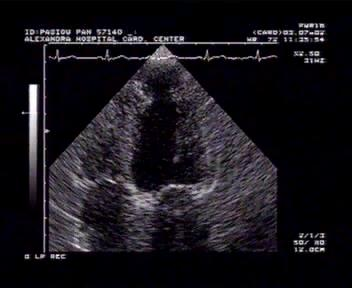 SLE : LV diastolic and