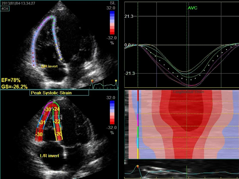 RIGHT VENTRICLE Horton et al J