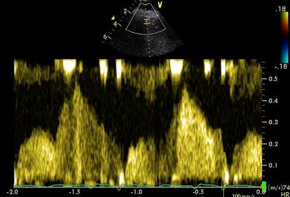 rest base adenosine IL-1ra