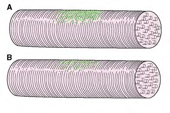 Βαριά Μυασθένεια ή Μυασθένεια Gravis 100-200 / 1.000.